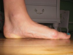 flat feet orthotics